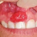 tumeur gingivale