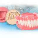 Prothèse numérique